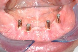 Bild: 4 Implantate Unterkiefer