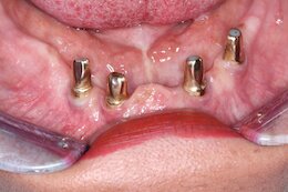 Bild: 4 Implantate Unterkiefer