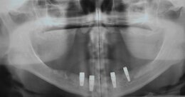 Röntgenbild: 4 Implantate Unterkiefer