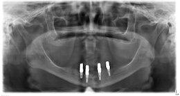 Röntgenbild: 4 Implantate Unterkiefer