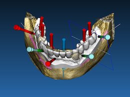 3d geführte Implantation als Grafik