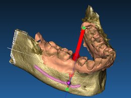 Beispiel eines 3D Zahnimplantates