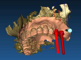 Ein weiteres Beispiel eines 3D Zahnimplantates