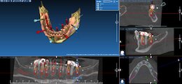 All on Six Zahnbehandlung 3D