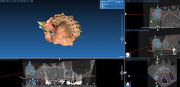implantatgetragene Versorgung