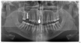Röntgenbild des Kiefers mit Implantat